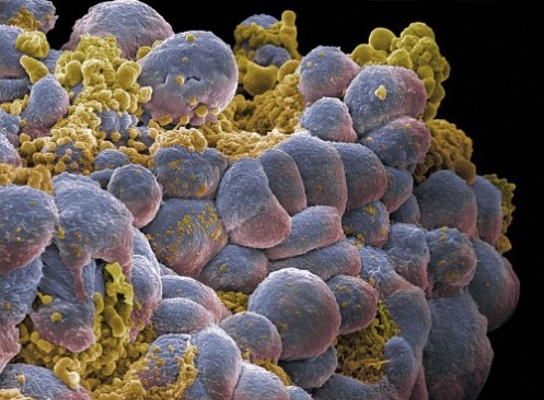 El tratamiento prohibido contra el cáncer que podría salvar su vida FUENTE http://elnuevodespertar.wordpress.com Celulas-cancerigenas